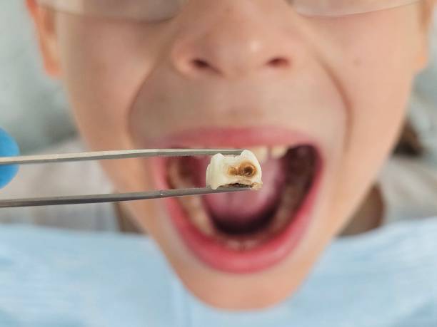 Best Emergency Tooth Extraction in Connerton, FL