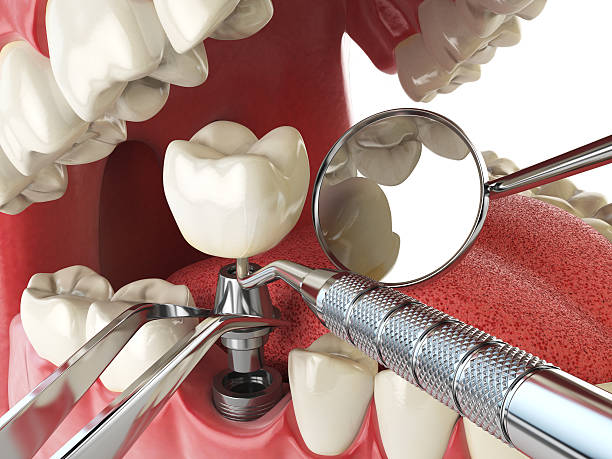 Best Emergency Broken Tooth Repair in Connerton, FL